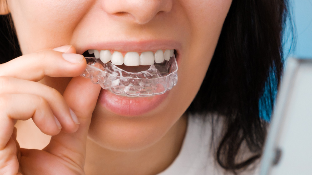 Invisalign