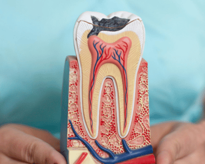 Odontologie - Tratament Carii Oradea