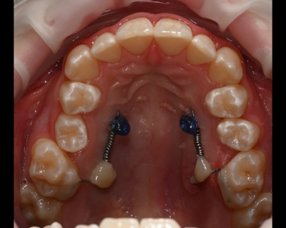 Mini implant ortodontic 2