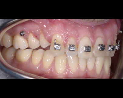 Mini implant ortodontic 1
