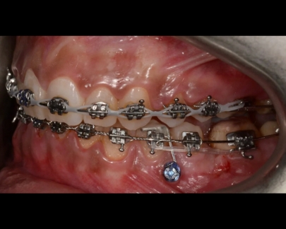 Mini implant ortodontic 3