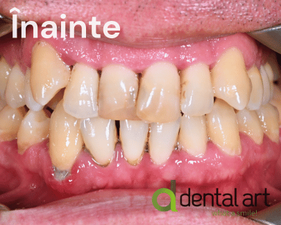 Parodontologie – Îngrijirea sănătății gingiilor și a osului dentar
