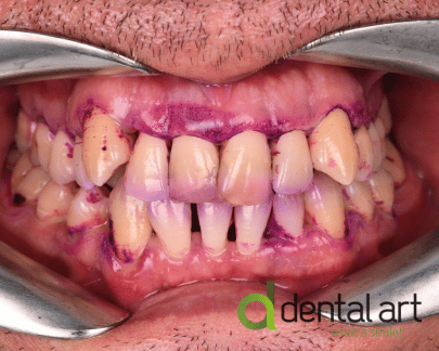Parodontologie – Îngrijirea sănătății gingiilor și a osului dentar