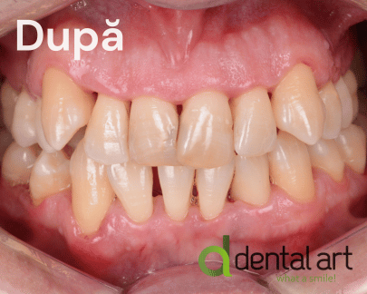 Parodontologie – Îngrijirea sănătății gingiilor și a osului dentar