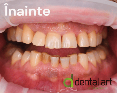 Parodontologie – Îngrijirea sănătății gingiilor și a osului dentar