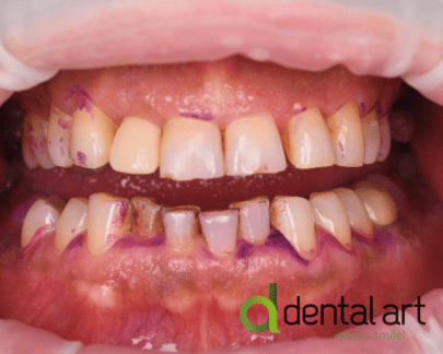 Parodontologie – Îngrijirea sănătății gingiilor și a osului dentar