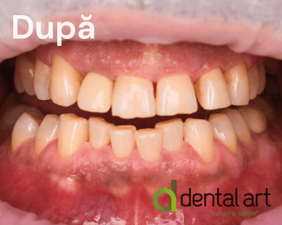 Parodontologie – Îngrijirea sănătății gingiilor și a osului dentar