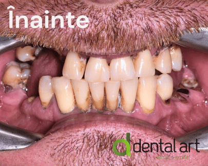 Parodontologie – Îngrijirea sănătății gingiilor și a osului dentar