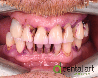 Parodontologie – Îngrijirea sănătății gingiilor și a osului dentar