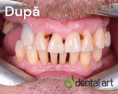 Parodontologie – Îngrijirea sănătății gingiilor și a osului dentar