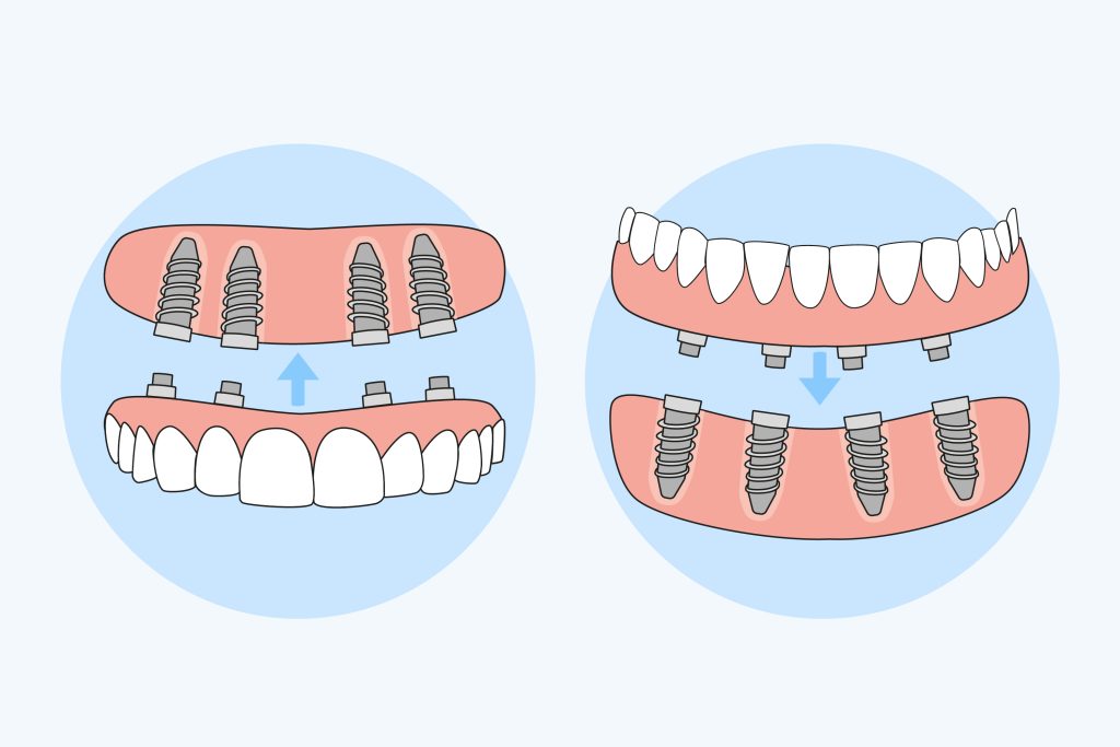 Implant dentar Oradea
