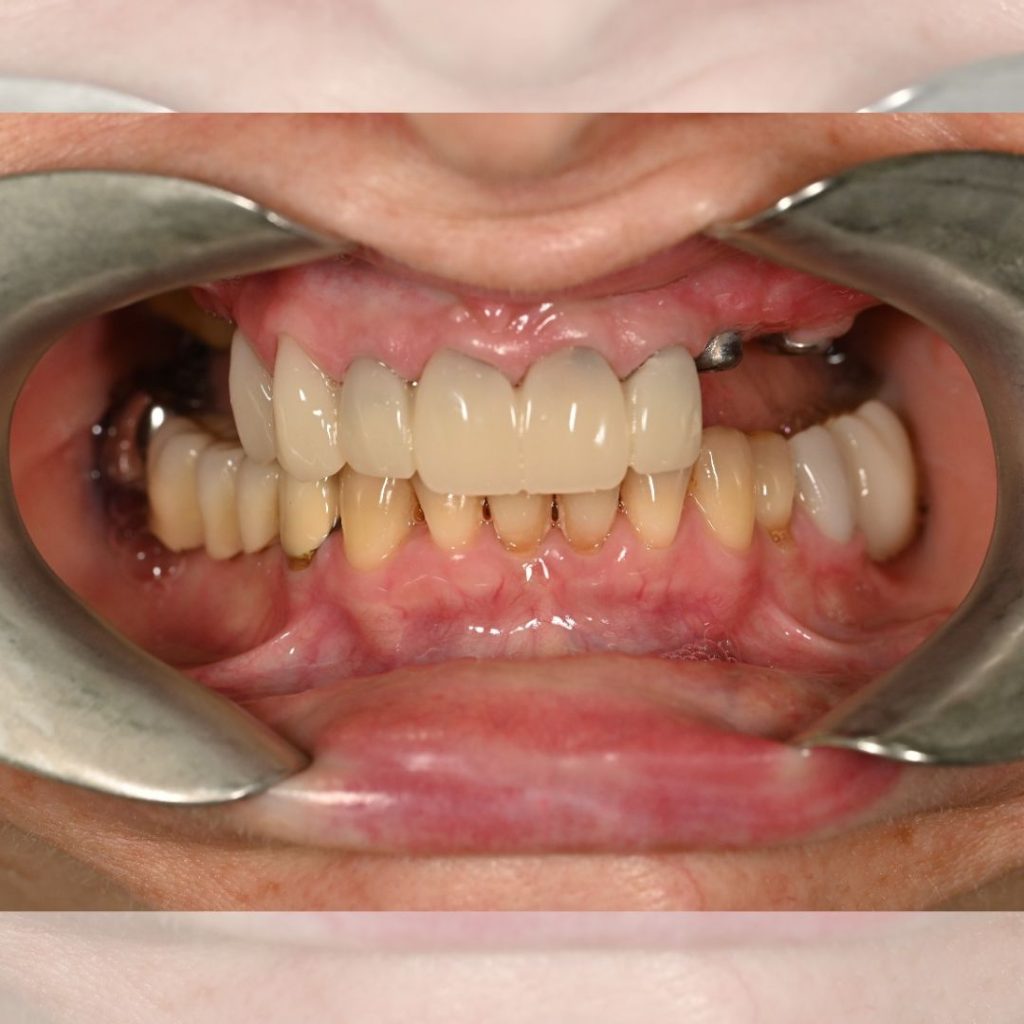 Implant dentar Oradea