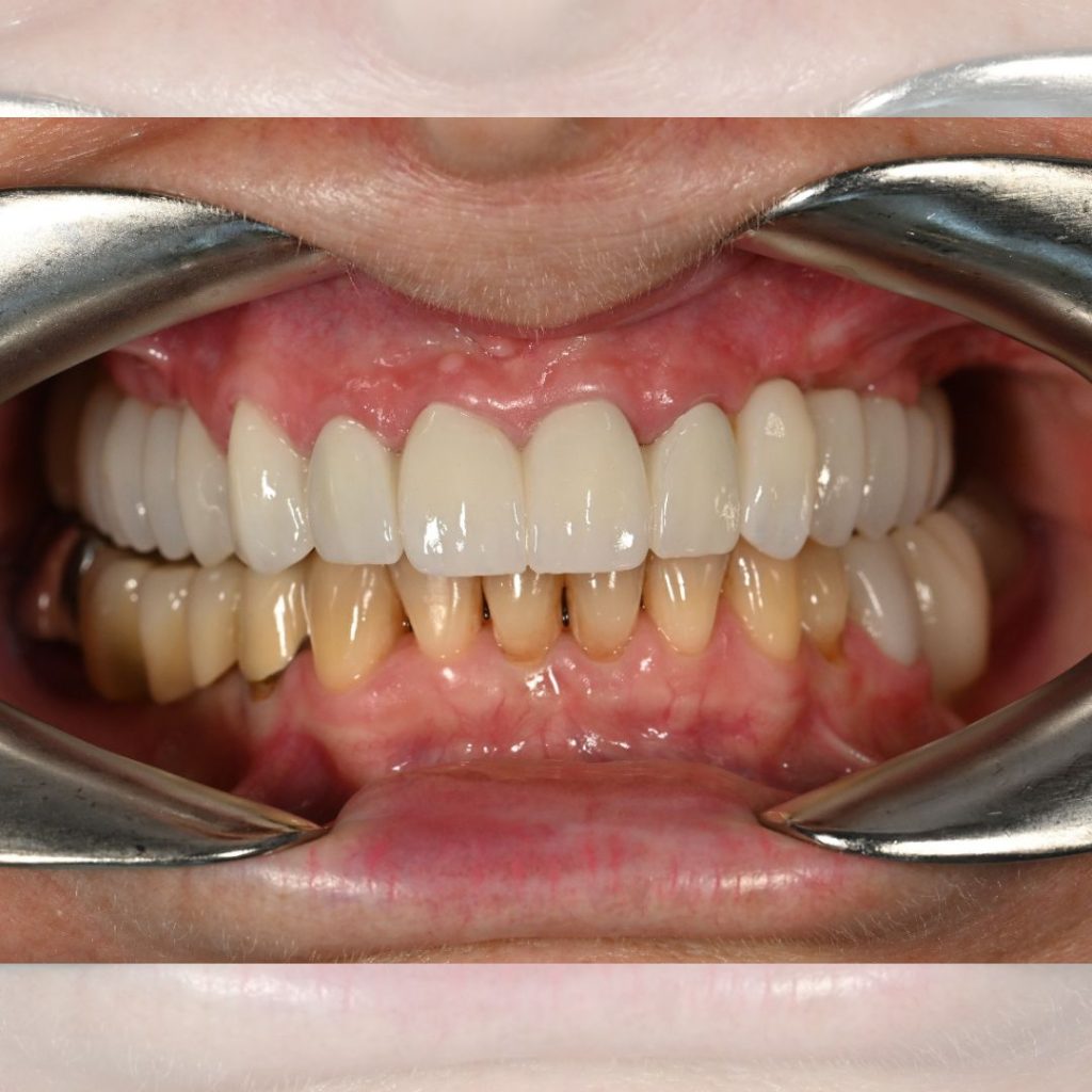 Implantologie Dentară Oradea