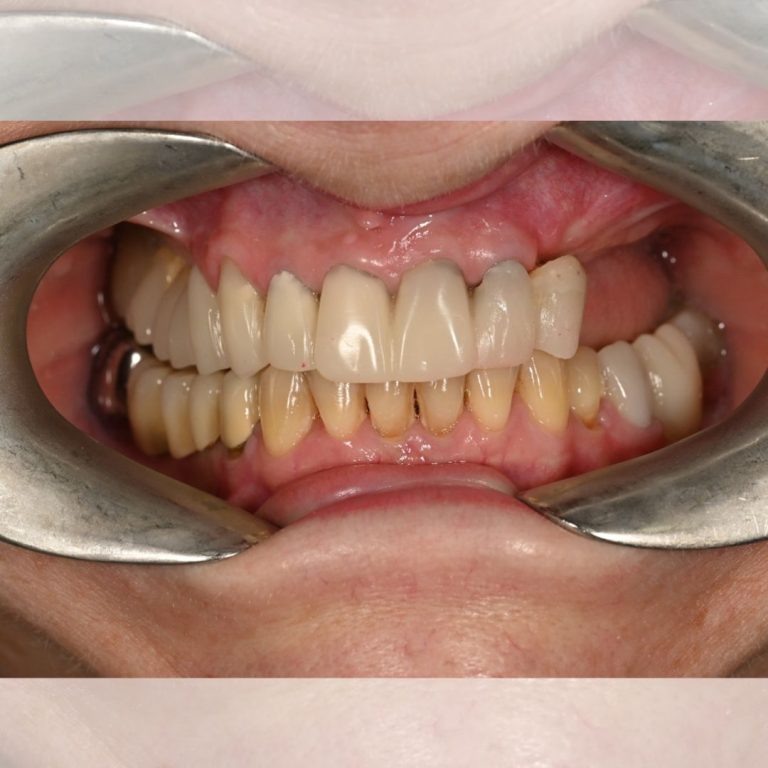 Implant dentar Oradea