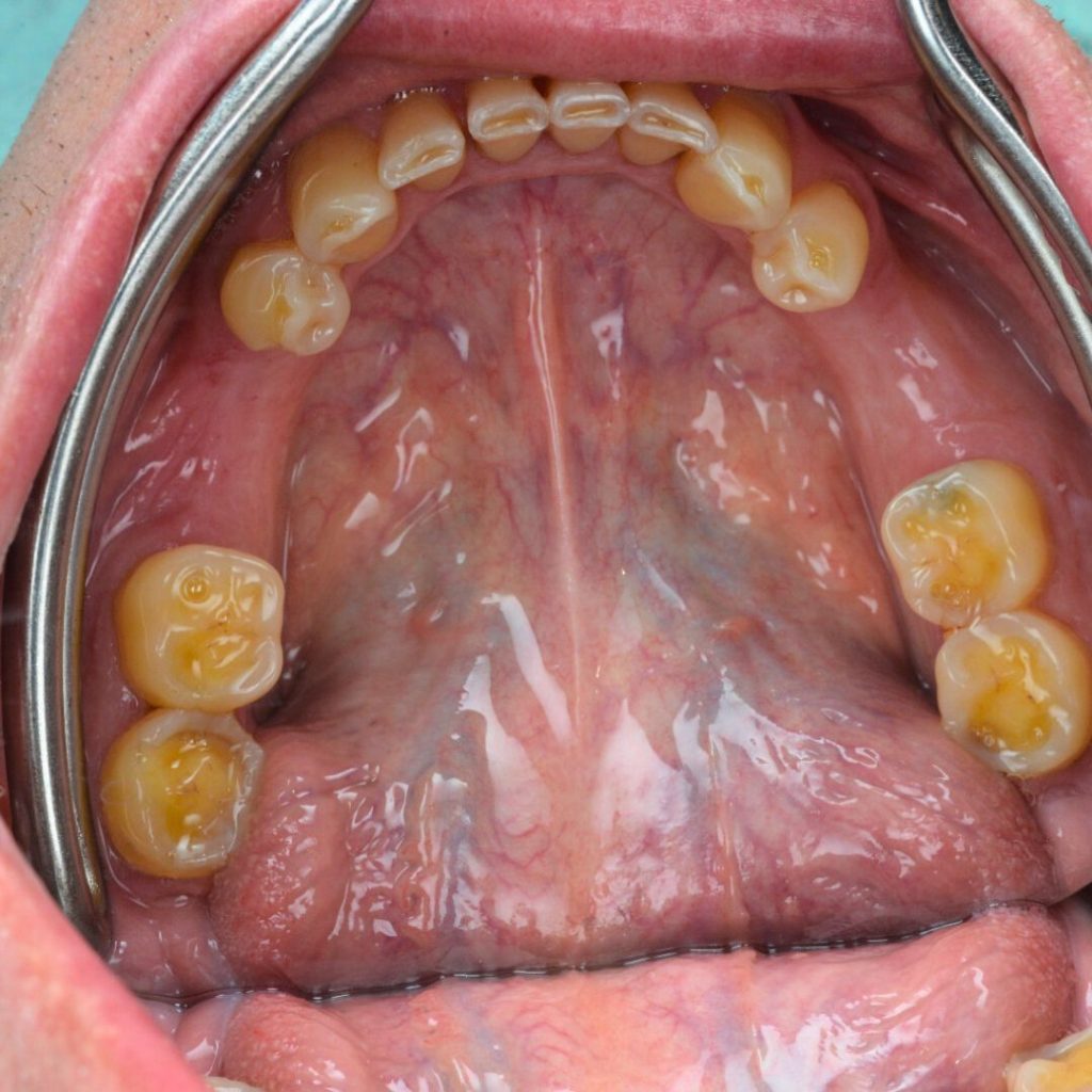 Implantologie Dentară Oradea
