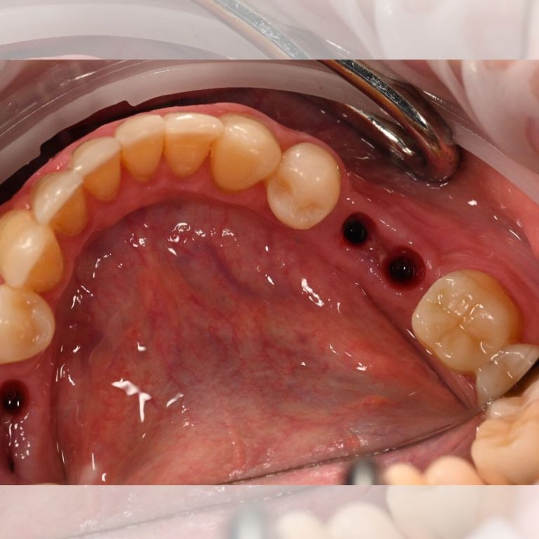Implantologie Dentară Oradea