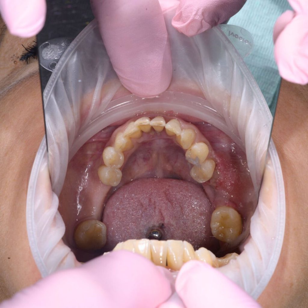 Implant dentar Oradea