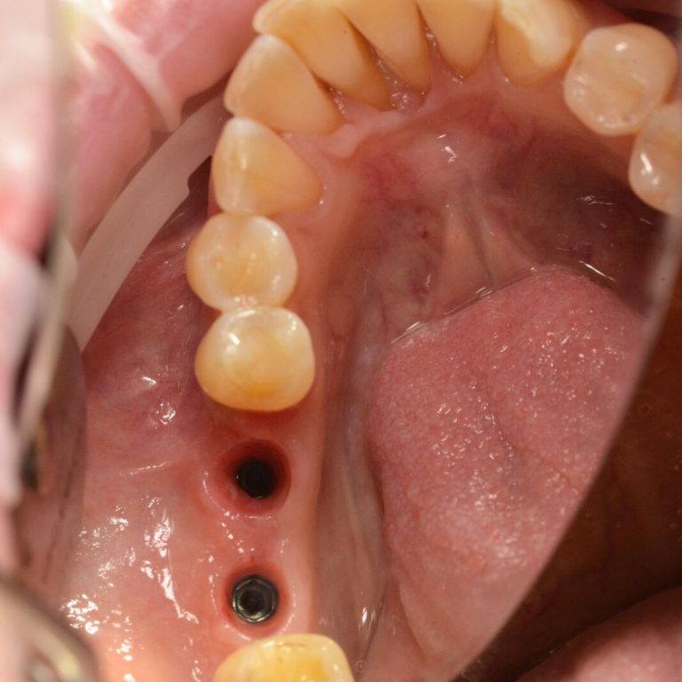 Implant dentar Oradea
