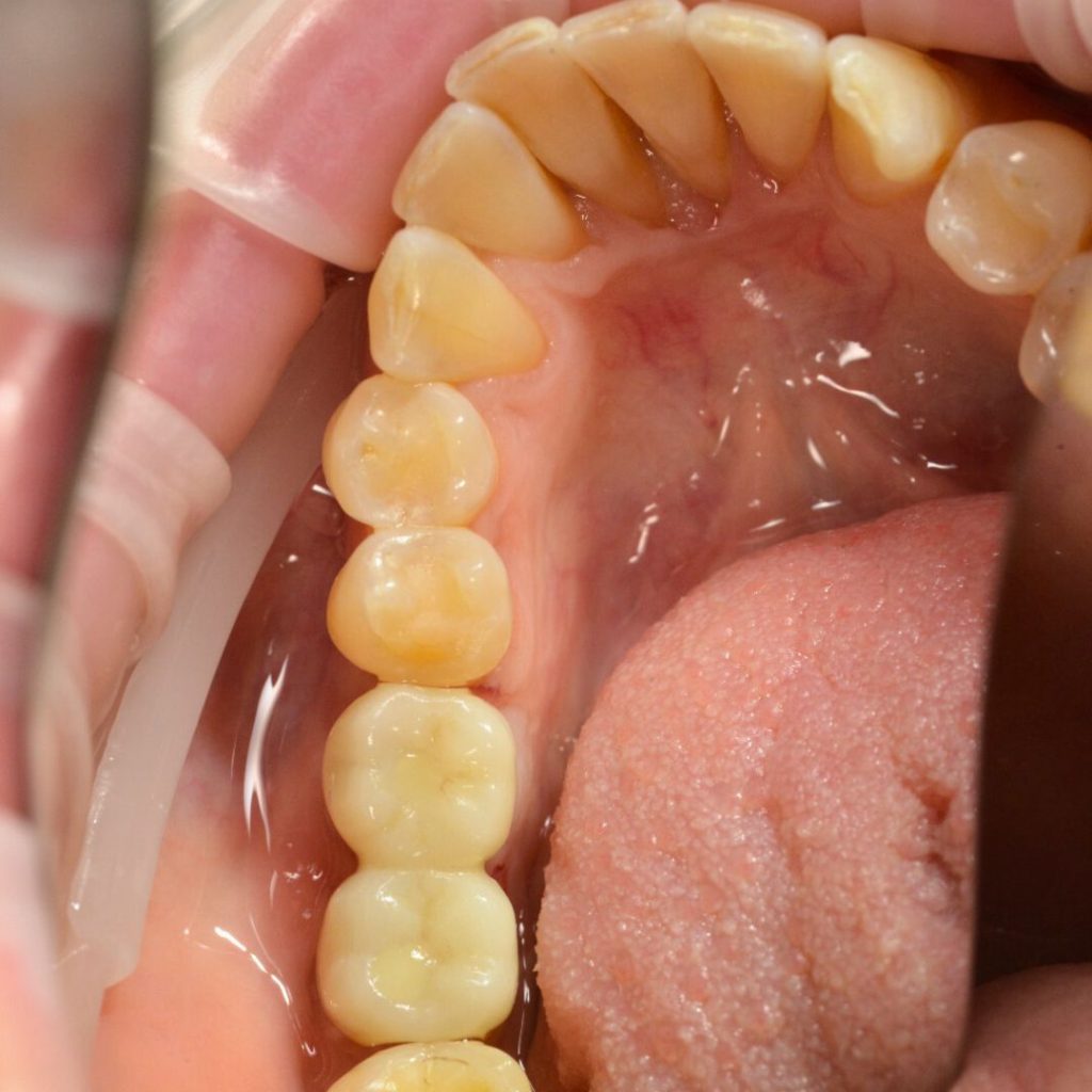 Implant dentar Oradea