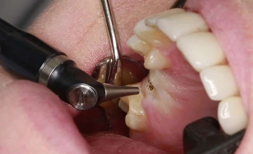 Dental Art - Tratamente cu laser