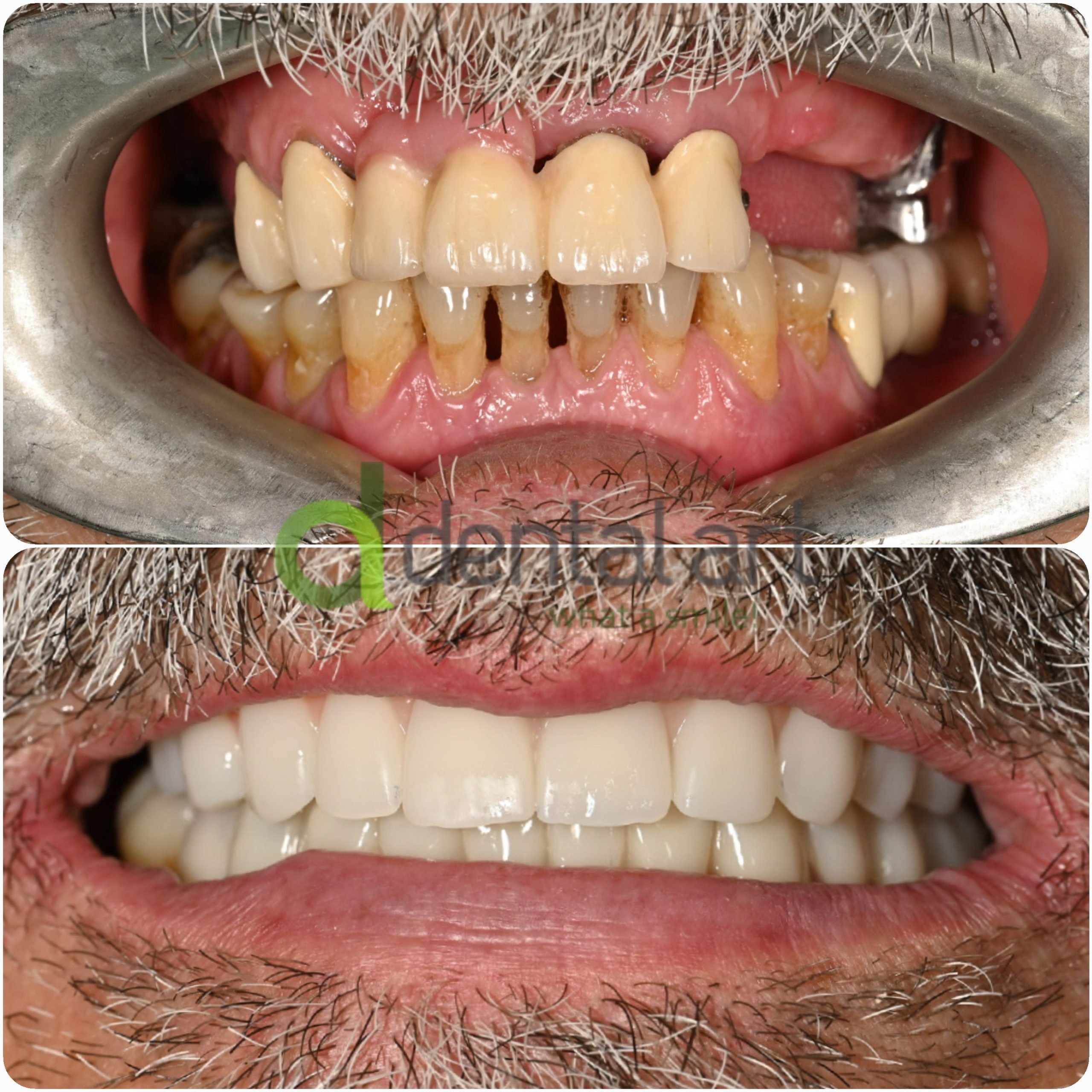 Parodontoza - Dental Art Oradea