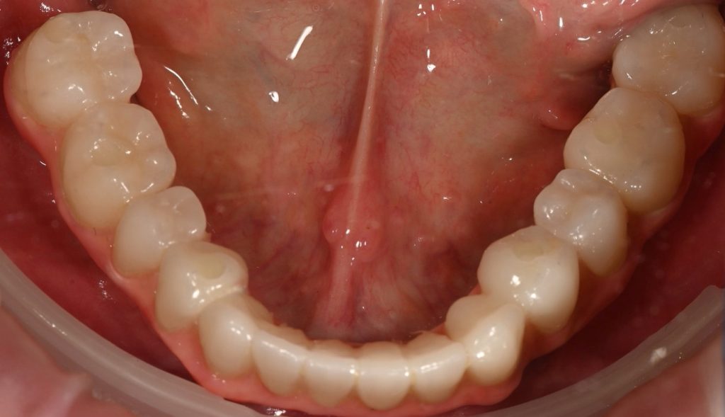 Lucrare All-on-X pe arcada inferioară – caz tratat la Dental-Art Oradea