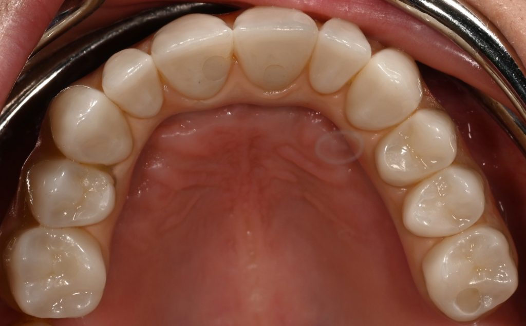 Lucrare All-on-X pe arcada superioară – caz tratat la Dental-Art Oradea