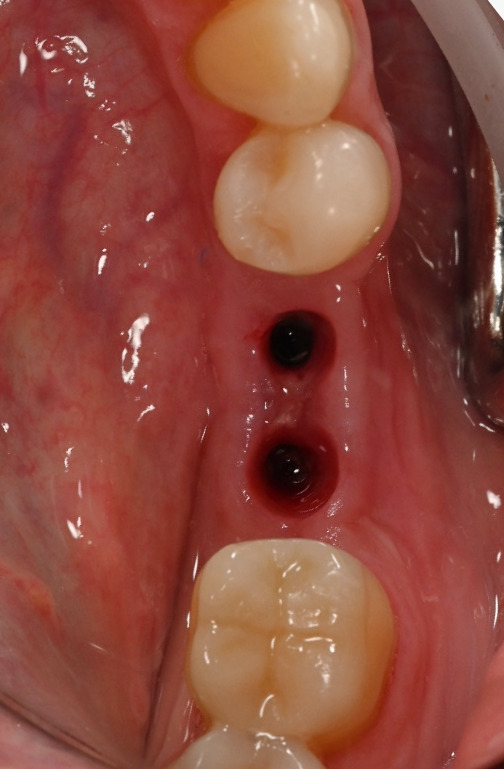 Caz 1 implant dentar: implanturi inserate, gingie vindecată – Dental-Art Oradea
