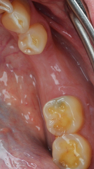 Caz 1 implant dentar: dinți lipsă înainte de tratament – Dental-Art Oradea
