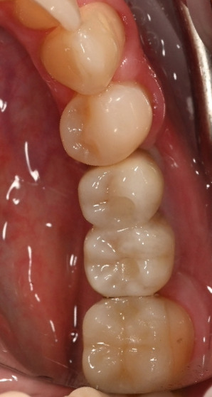 Caz 1 implant dentar: lucrarea finală pe implanturi – Dental-Art Oradea