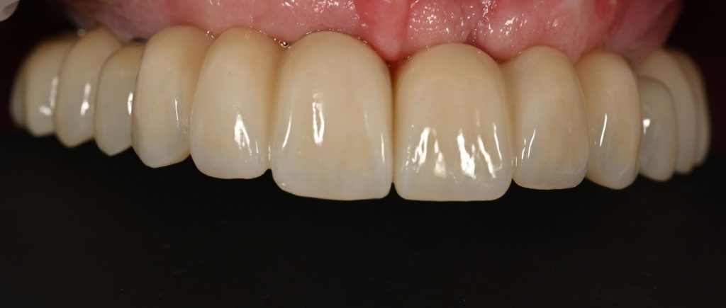 Caz 2 All-on-6 superior: lucrarea pe implanturi, vedere frontală – Dental-Art Oradea