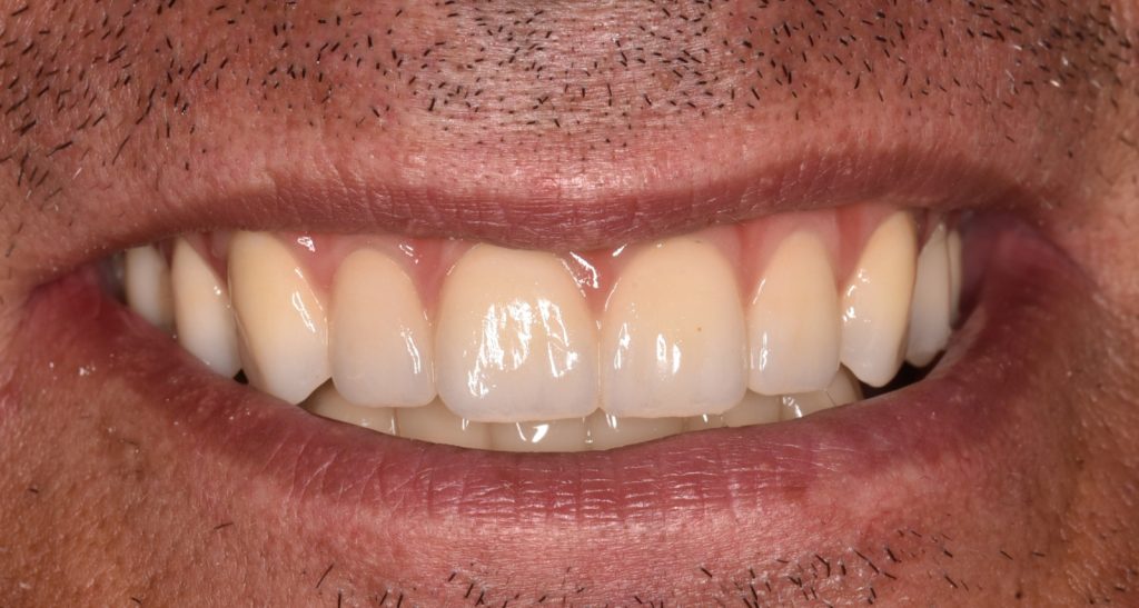 Caz 2 All-on-6 superior: zâmbetul pacientului după tratament – Dental-Art Oradea