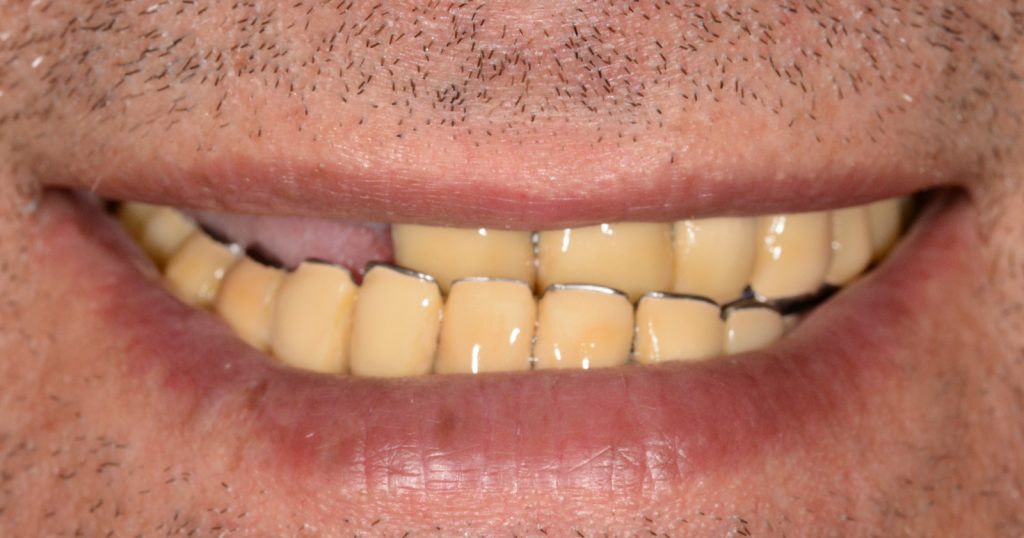 Caz 3 All-on-6 inferior: zâmbetul pacientului înainte de tratament – Dental-Art Oradea