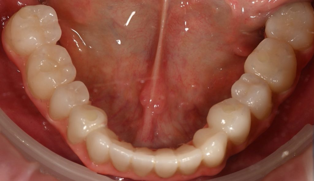 Caz 3 All-on-6 inferior: lucrarea pe implanturi, vedere ocluzală – Dental-Art Oradea