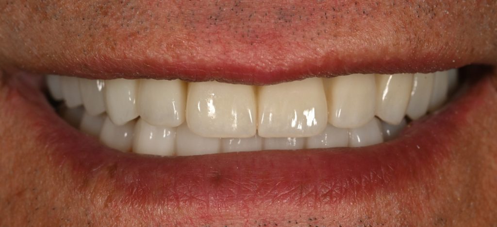Caz 3 All-on-6 inferior: zâmbetul pacientului după tratament – Dental-Art Oradea